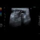 Acute appendicitis, fecolith: US - Ultrasound